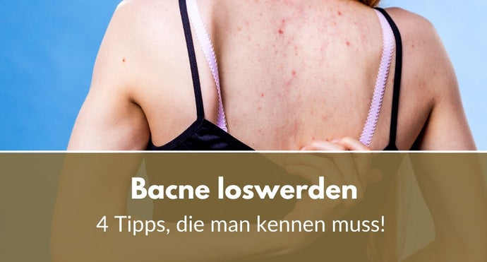 Bacne loswerden: 4 Tipps, die man kennen muss!