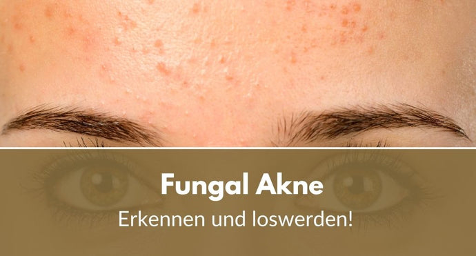 So können Sie Fungal Akne erkennen und loswerden!