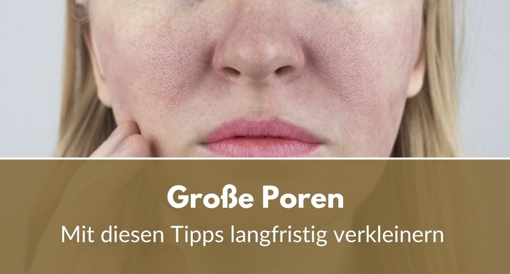 Große Poren: Mit diesen Tipps verkleinert man sie langfristig