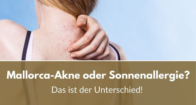 Mallorca-Akne oder Sonnenallergie? So erkennst du’s sofort