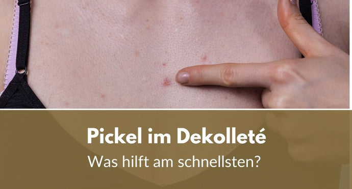 Pickel im Dekolleté: Was hilft am schnellsten?