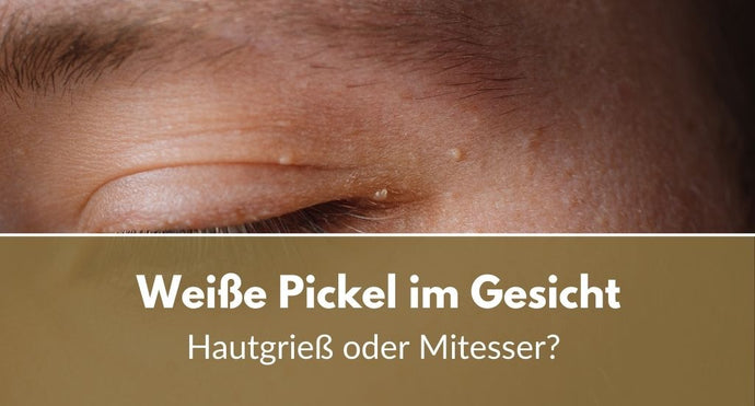 Weiße Pickel im Gesicht: Hautgrieß oder Mitesser?
